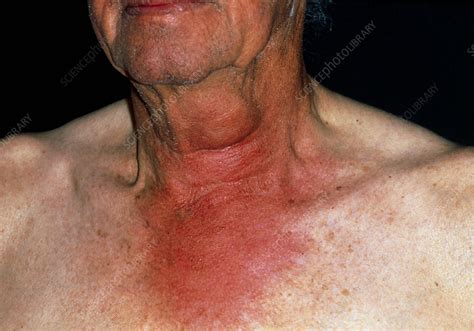 Man's swollen neck due to a wasp sting - Stock Image - M320/0212 - Science Photo Library