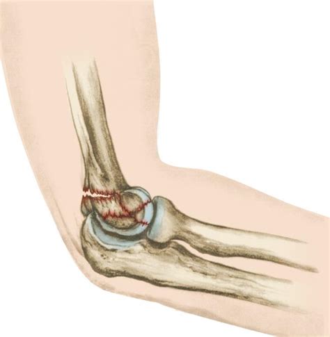 Left Humerus Fracture