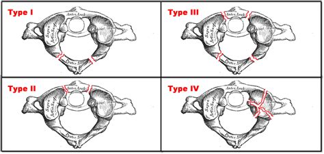 Cureus | Atlas Fracture with Concomitant Vertebral Artery Hypoplasia, a Rare but Potentially ...