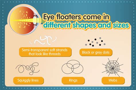 Can Contact Lenses Caused Eye Floaters? — UNIQSO