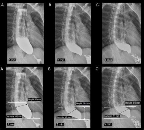 Timed barium swallow in the assessment of esophageal emptying in patients with achalasia: How to ...