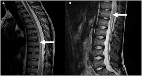 Transverse Myelitis Symptoms, Causes, Diagnosis and Treatment - Natural Health News