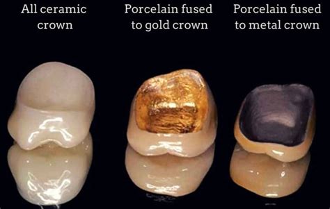 Dental crown procedure and process, what a dental crown look like