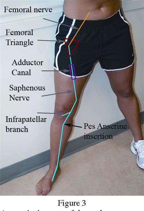 Figure 6 from Entrapment of the saphenous nerve at the adductor canal ...