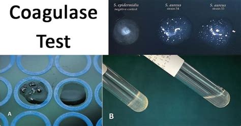 Coagulase Test- Principle, Procedure, Types, Result, Uses