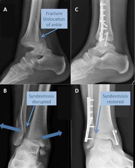 Ankle Fracture | Types & Treatment | The London Foot & Ankle Clinic