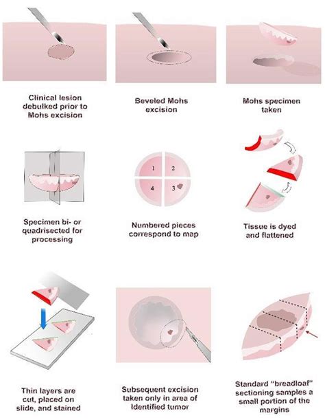 Mohs Micrographic Surgery - Skin Cancer, Advantages, Complications