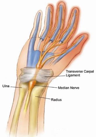 median nerve entrapment - Neurosurgeons of New Jersey