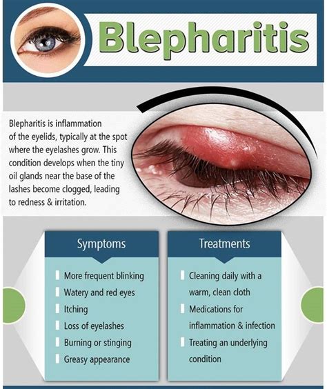 #Blepharitis #Eyelids #Eyelashes To Know more about #Blepharitis #Visit :http://www ...