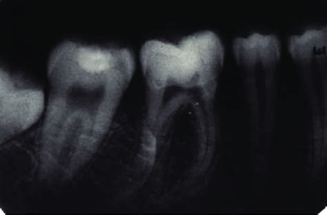 Intraoral periapical radiograph with 46 at 2 years followup. No... | Download Scientific Diagram