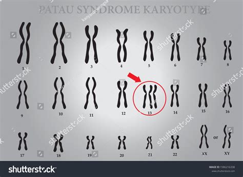 Patau Syndrome Karyotype One Chromosomal Disorders: เวกเตอร์สต็อก (ปลอด ...