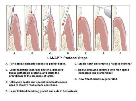 Periodontal Laser Therapy Rocky Mount NC | LANAP Protocol