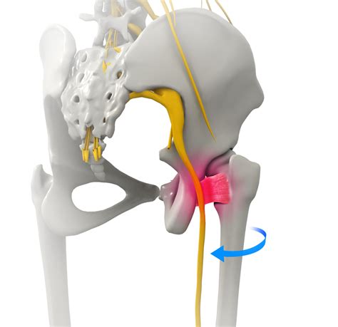 Ischiofemoral Impingement DecompressionOrland Park, IL | Hip ImpingementOrland Park, IL