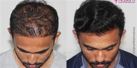 wrong hair transplant before after india