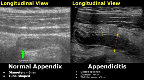 SOLUTION: Appendix Ultrasound Normal Vs Abnormal Image Appearances Comparison - Studypool