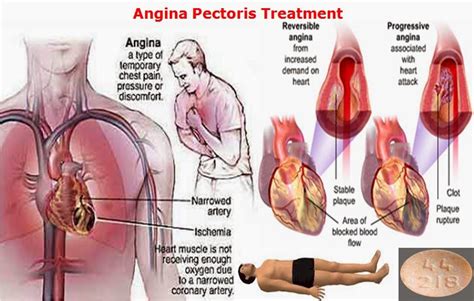 Angina Chest Pain & Tightness, Symptoms, Types & Treatment