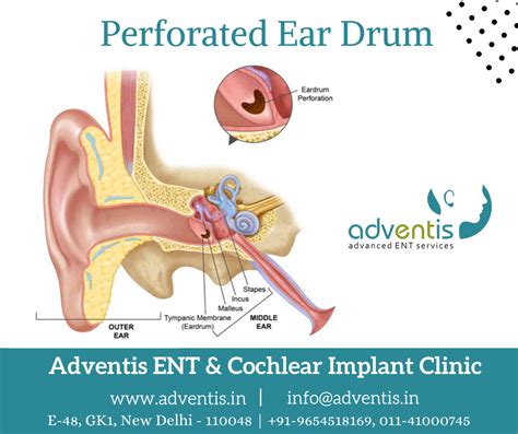 Perforated Ear Drum Infection Treatment in Delhi, India | Adventis