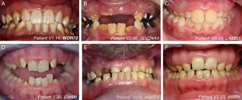 Amelogenesis Imperfecta Types