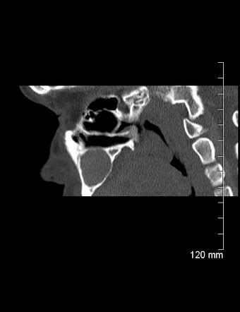 Central giant cell granuloma | Radiology Case | Radiopaedia.org