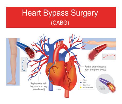 What Is A Triple Bypass Heart Surgery