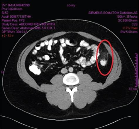 Epiploic Appendagitis Mimicking Diverticulitis | Consultant360