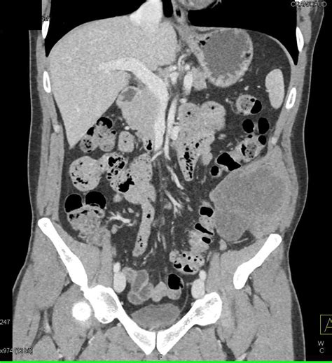 Liposarcoma Involves Abdominal Wall - Musculoskeletal Case Studies - CTisus CT Scanning