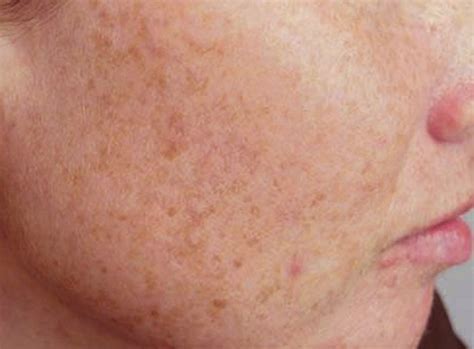 Liver Spots: Causes, Treatments, and Removal Options | HealDove