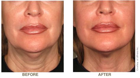 Ultherapy: A non surgical Uplift, not a Facelift! | Canton, MA Patch