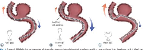 Figure 1 from The Evolution of Flow-Diverting Stents for Cerebral ...