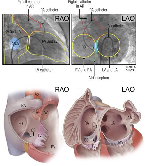 Transseptal Techniques for Emerging Structural Heart Interventions | JACC: Cardiovascular ...