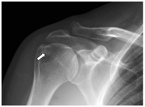 Anterior greater tuberosity subcortical cyst formation indicative of supraspinatus tear