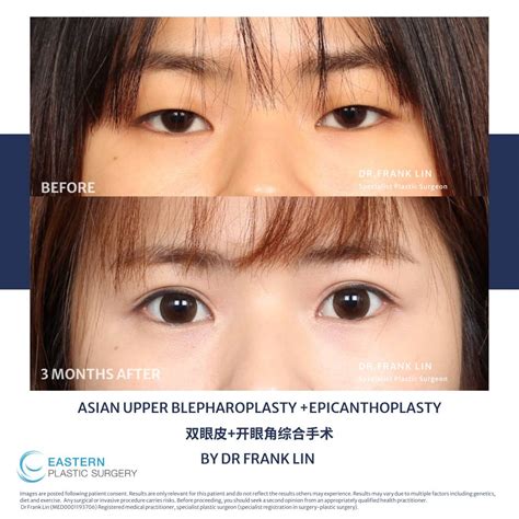 Double Eyelid Surgery Before and After| Eastern Plastic Surgery