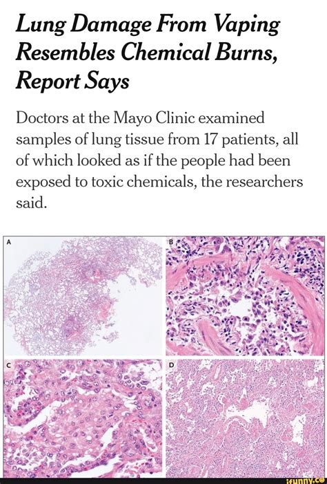 Lung Damage From Vaping Resembles Chemical Burns, Report Says Doctors at the Mayo Clinic ...