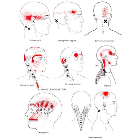 Head Aches And Trigger Point Therapy - Lisa de Liema