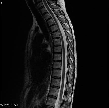 1st Lumbar Spine Cyst