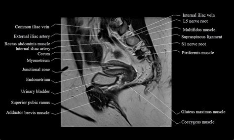 MRI Female Pelvis Anatomy | Free MRI Sagittal Cross Sectional Anatomy of Female Pelvis