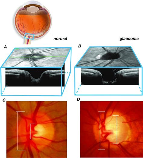 Structural damage to optic nerve head in glaucoma imaged by optical... | Download Scientific Diagram