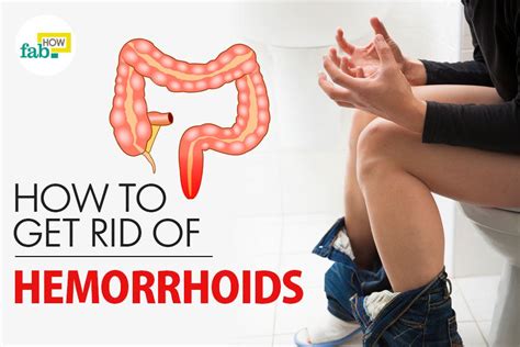 How to Get Rid of Hemorrhoids without Surgery | Fab How