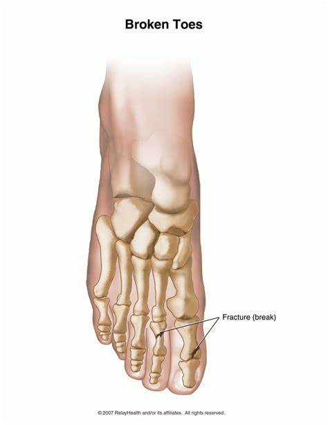 Broken Toe – Symptoms, Diagnosis, Treatment and Pictures