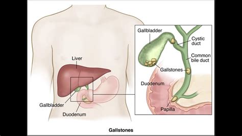 Choledocholithiasis (Bile Duct Stones) - MR YAHYA AL-HABBAL