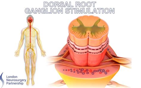 Dorsal root ganglion stimulation - London Neurosurgery Partnership