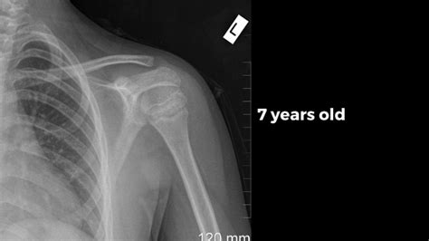 Shoulder X Ray Positioning