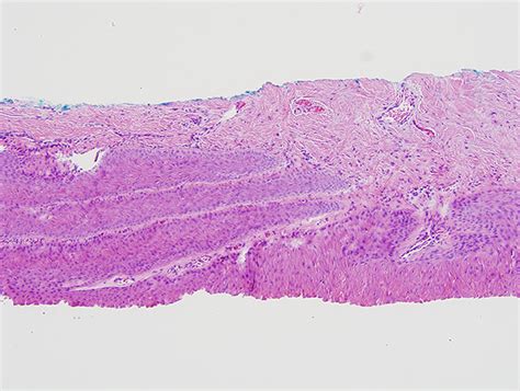 Onychopapilloma with Supervening Warty Changes | Dermatopathology