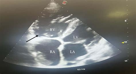 A case report: intravenous leiomyomatosis extending from the ...