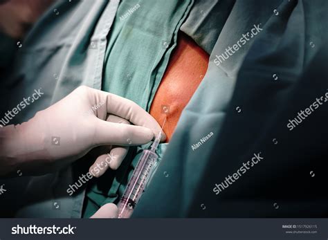 Step By Step Excision Biopsy Back Stock Photo 1517926115 | Shutterstock