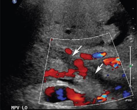 Portal vein thrombosis. Doppler ultrasound of the main portal vein following liver transplant ...