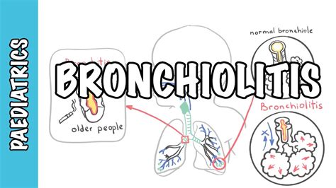 Bronchiolitis (causes, pathophysiology, signs and symptoms, treatment ...