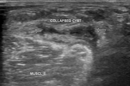 Baker cyst | Radiology Reference Article | Radiopaedia.org