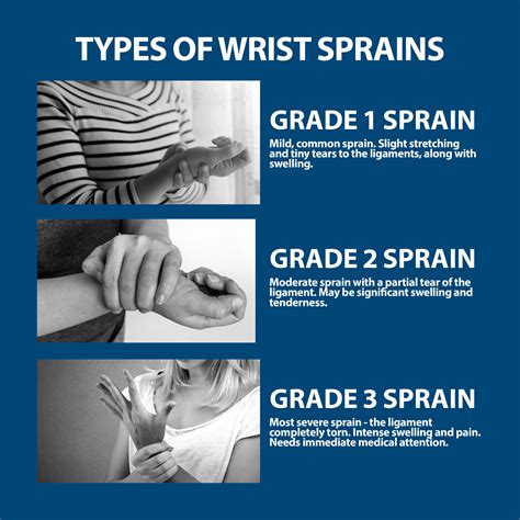 Sprained Wrist Symptoms | Florida Orthopaedic Institute