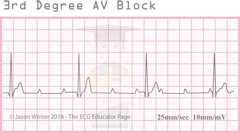 3rd Degree AV Block (Complete Heart Block) #Clinical ... | GrepMed